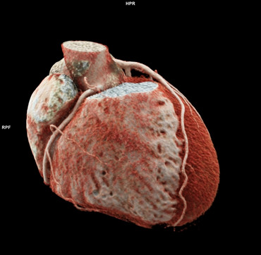 3D-Cinematic-Rendering Bild der kontrastmittelgefüllten Herzkammern und Herzkranzgefäße